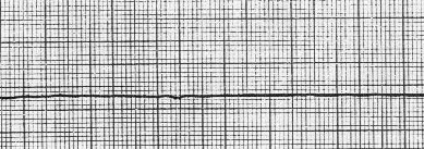 \includegraphics[width=.7\linewidth]{asystole.eps}